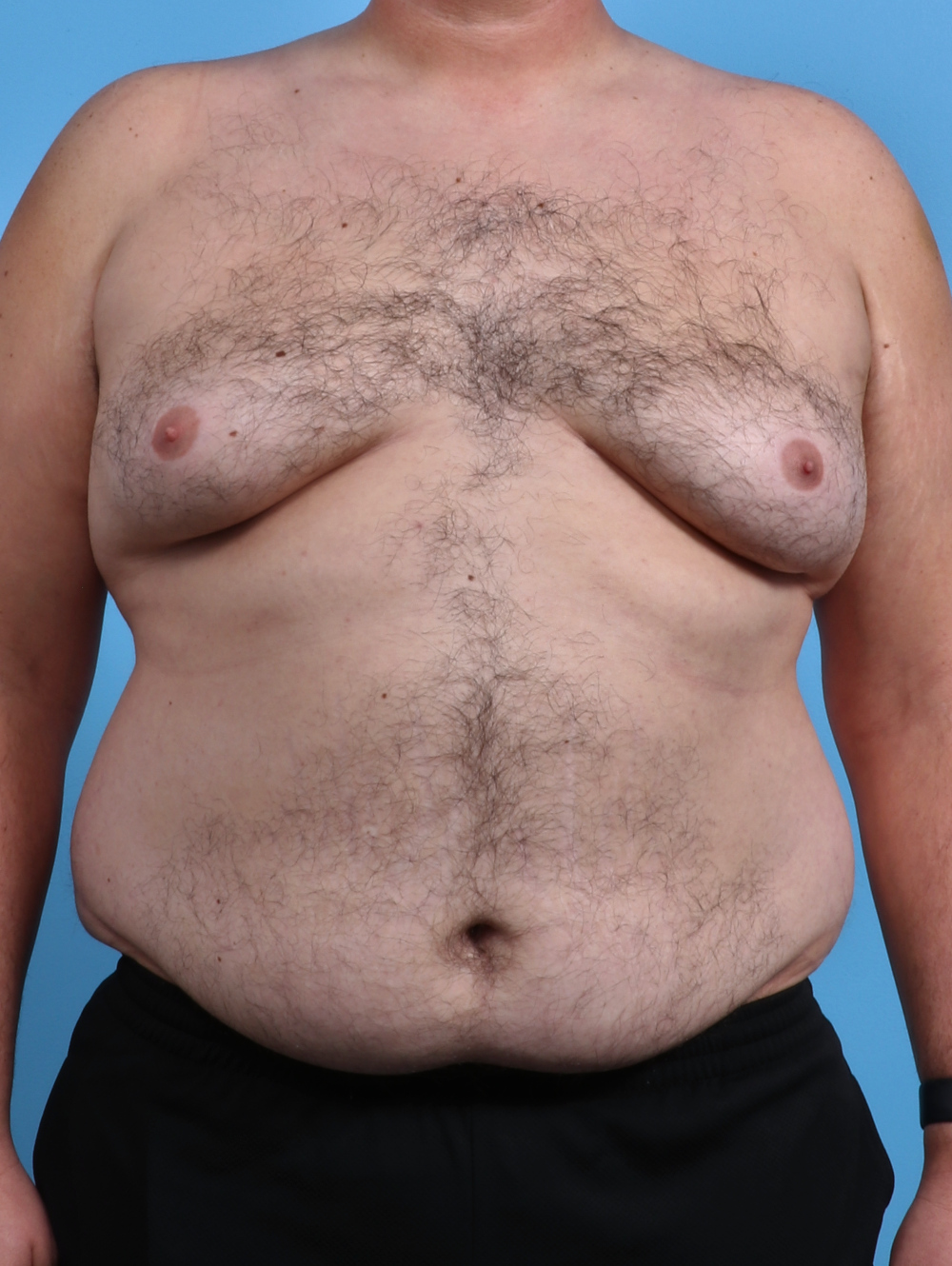 Before Male Breast Reduction