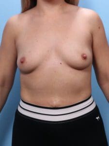 Breast Augmentation - Case 1810 - Before