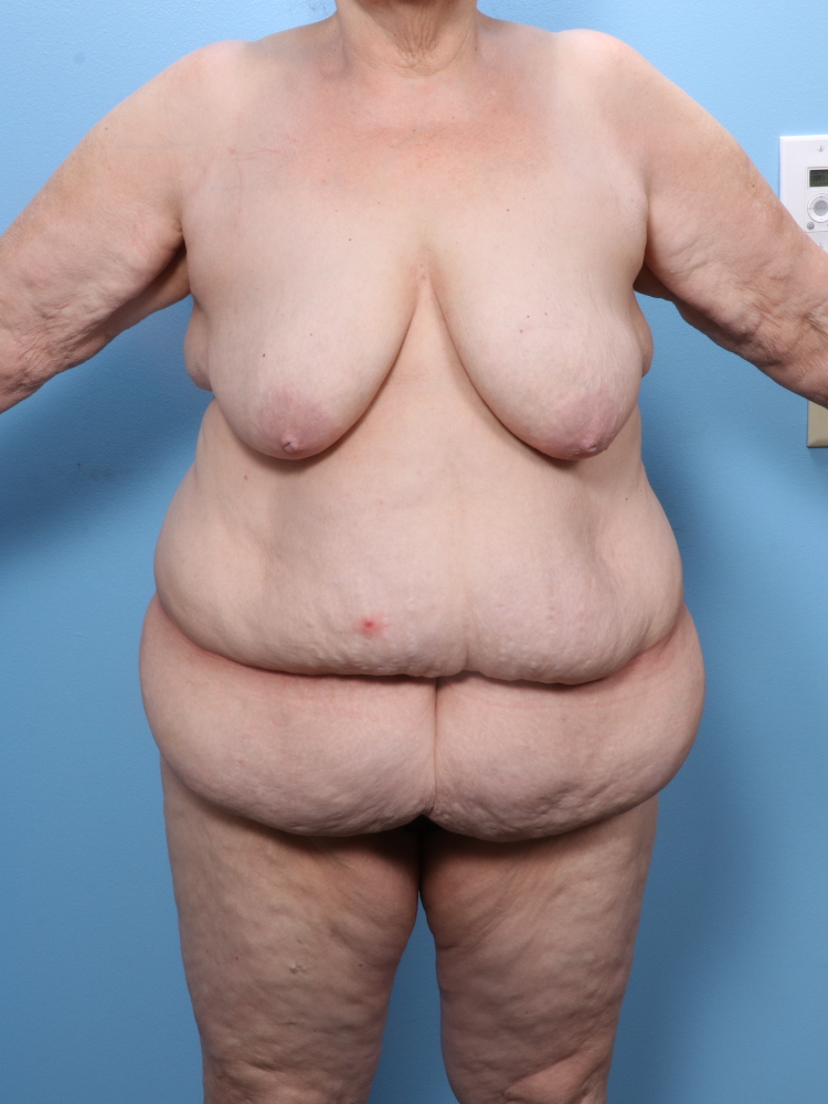 Breast Lift/Reduction w/o Implants Patient Photo - Case 1809 - before view-0