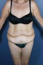After Weight Loss - Case 1218 - Before