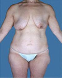 After Weight Loss - Case 1177 - Before