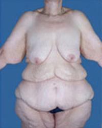 After Weight Loss - Case 1173 - Before