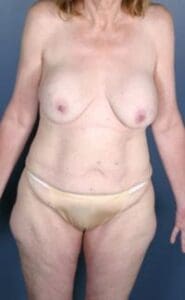After Weight Loss - Case 1229 - Before