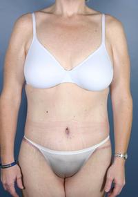 After Weight Loss - Case 1167 - After