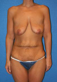After Weight Loss - Case 1163 - Before