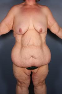 After Weight Loss - Case 1213 - Before