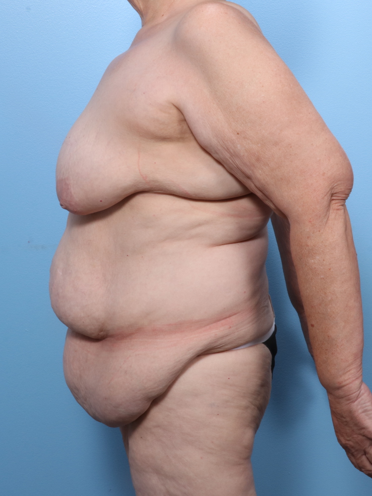 Breast Lift/Reduction w/o Implants Patient Photo - Case 1809 - before view-2