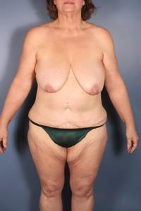 After Weight Loss - Case 1214 - Before