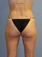 CoolSculpting - Case 1510 - Before