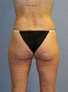 CoolSculpting - Case 1510 - Before