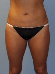 CoolSculpting - Case 1586 - Before