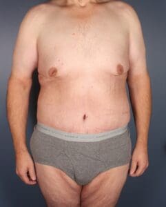 After Weight Loss - Case 1370 - After