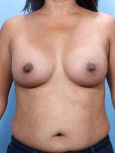 Breast Augmentation - Case 1659 - After