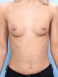 Breast Augmentation - Case 1667 - Before