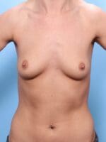 Breast Augmentation - Case 1680 - Before