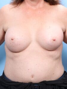 Breast Augmentation - Case 1703 - After