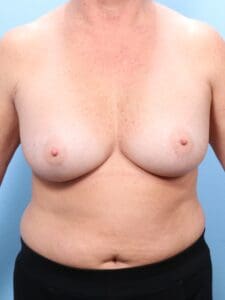 Breast Augmentation - Case 1716 - After