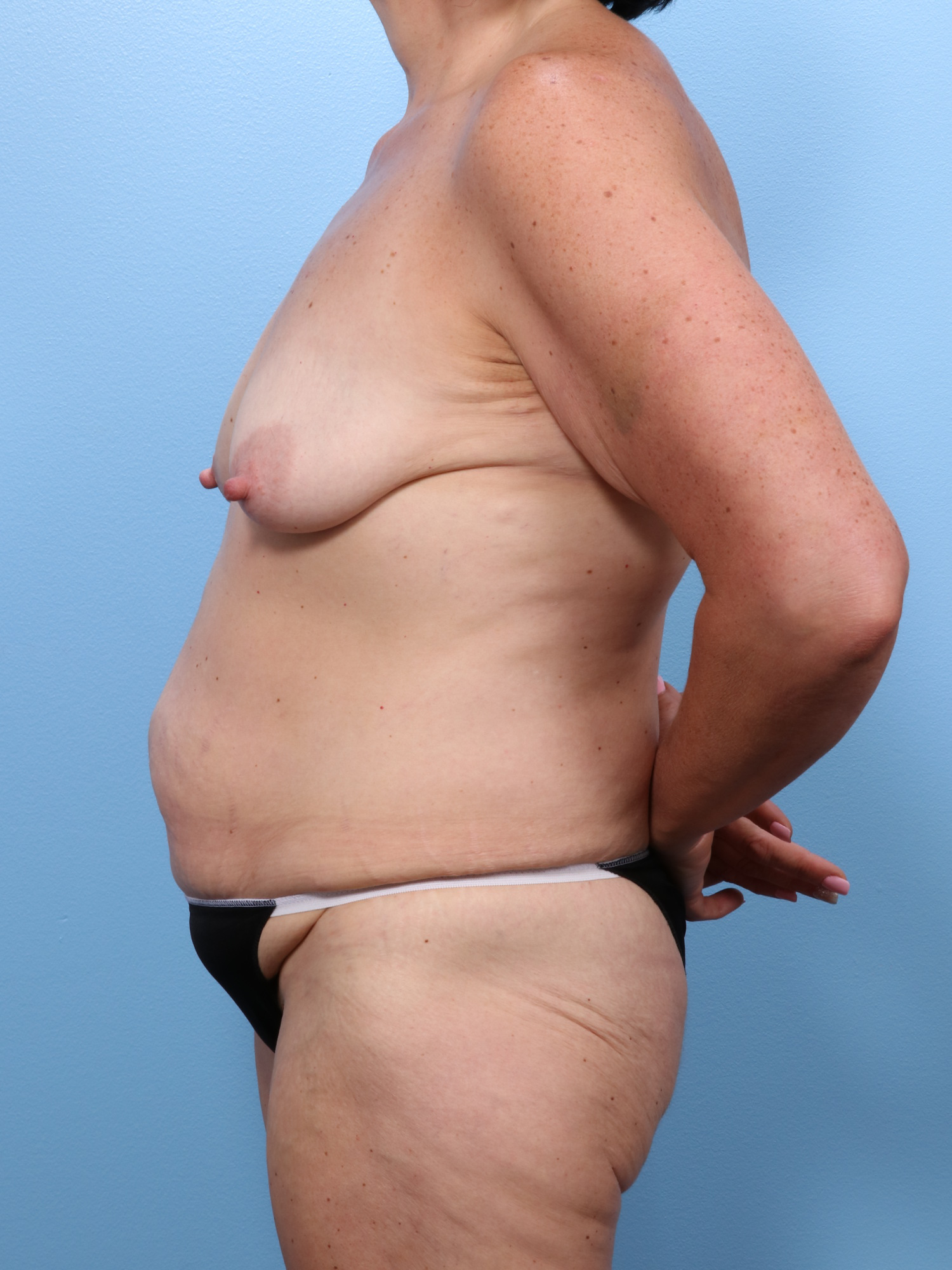 Tummy Tuck Patient Photo - Case 1720 - before view-2