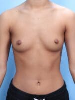 Breast Augmentation - Case 1733 - Before