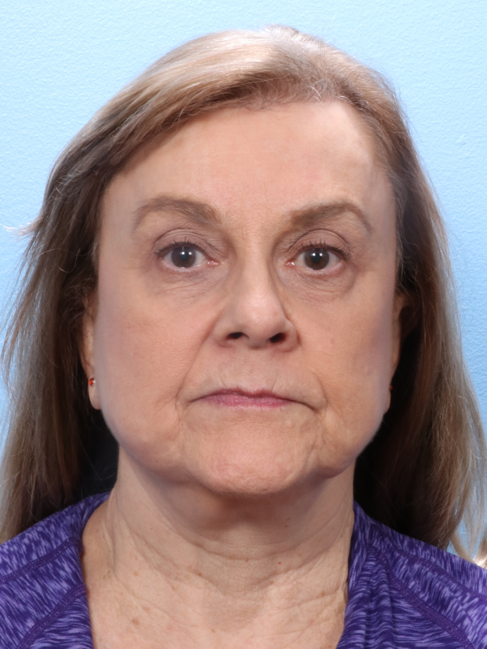 Brow Lift Patient Photo - Case 1735 - after view
