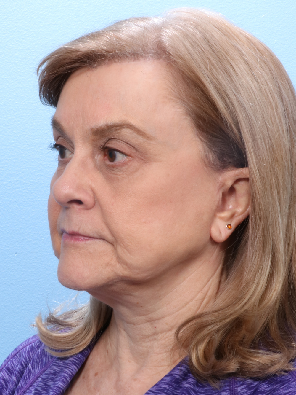 Brow Lift Patient Photo - Case 1735 - after view-1