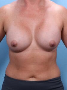 Breast Augmentation - Case 1754 - After