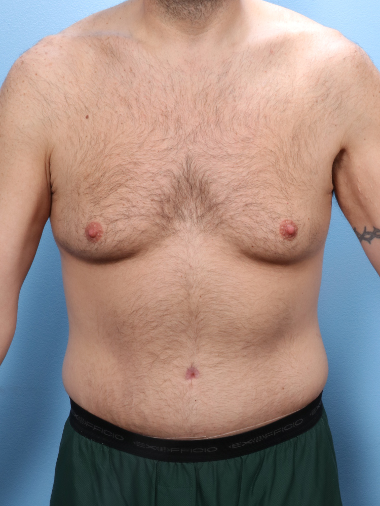 Male Tummy Tuck - Case 1760 - After