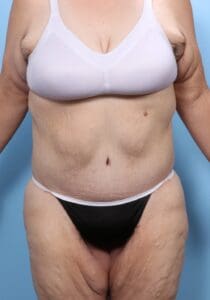 Tummy Tuck - Case 1768 - After