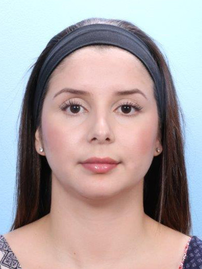 Rhinoplasty Patient Photo - Case 1769 - after view-1