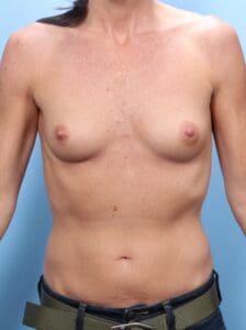 Breast Augmentation - Case 1790 - Before