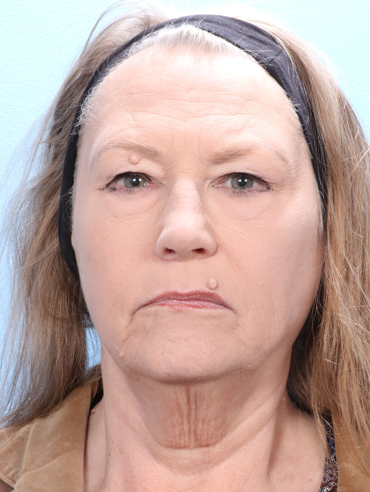 Eyelid Surgery Patient Photo - Case 1791 - before view-