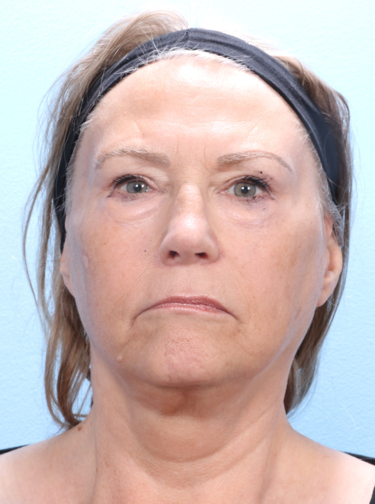 Eyelid Surgery Patient Photo - Case 1791 - after view
