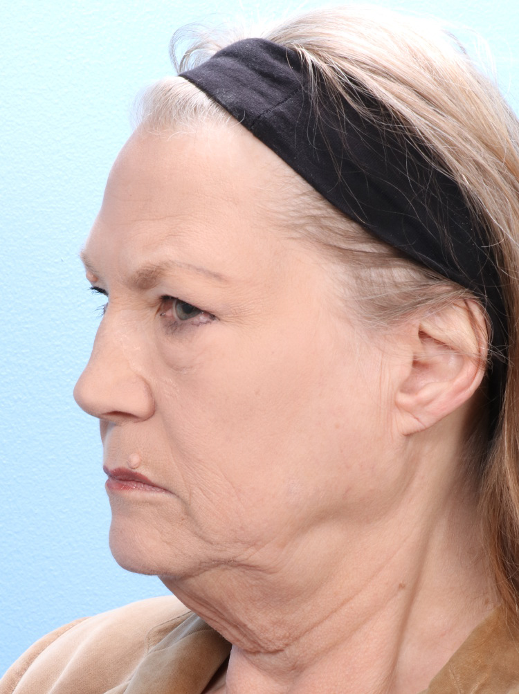 Eyelid Surgery Patient Photo - Case 1791 - before view-2