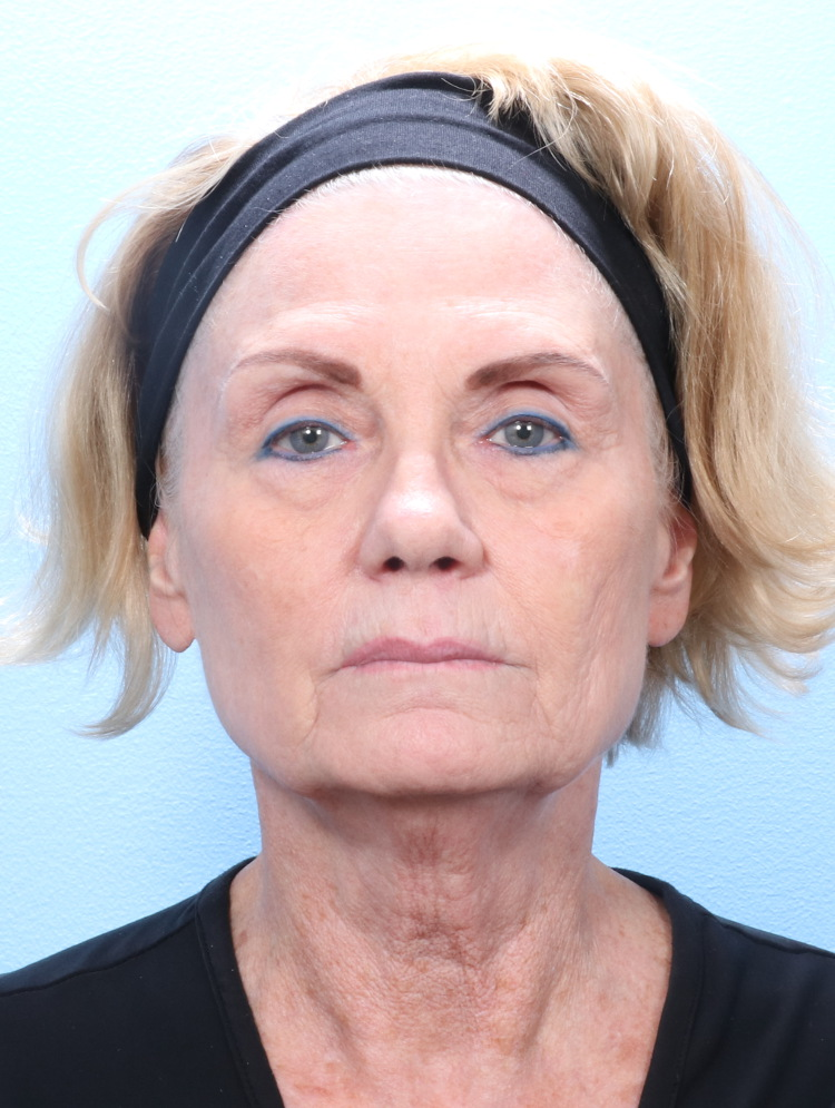 Brow Lift Patient Photo - Case 1793 - before view-