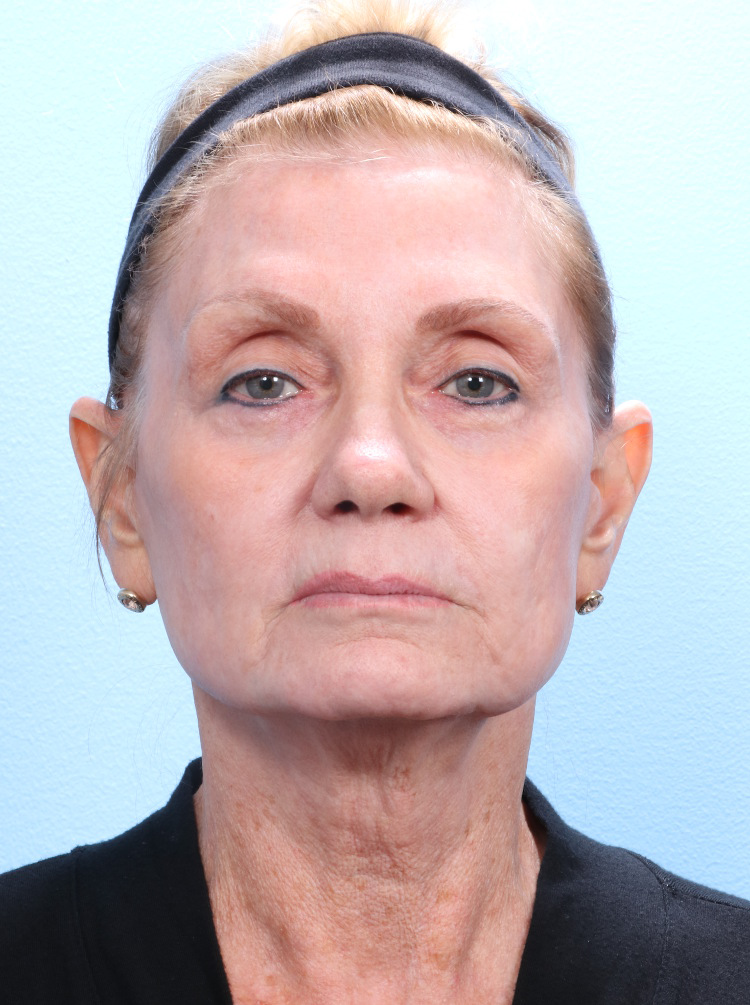Brow Lift Patient Photo - Case 1793 - after view