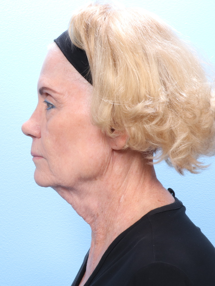 Brow Lift Patient Photo - Case 1793 - before view-2