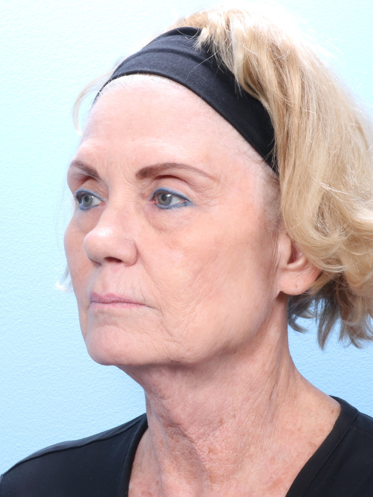 Brow Lift Patient Photo - Case 1793 - before view-1