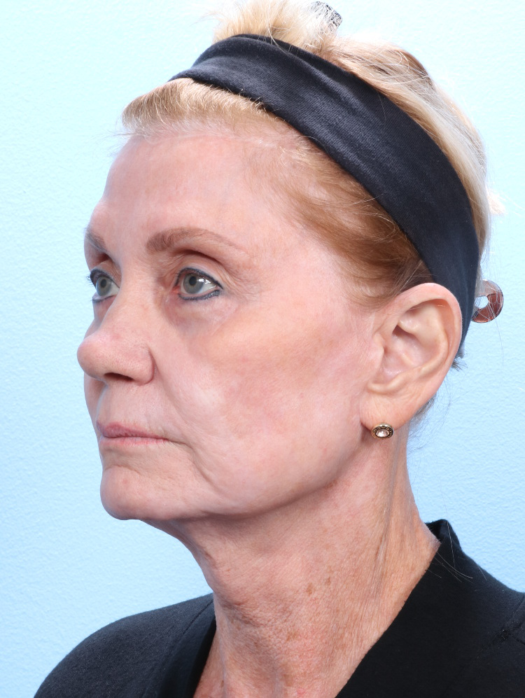 Brow Lift Patient Photo - Case 1793 - after view-1