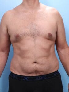 Male Liposuction - Case 1800 - Before