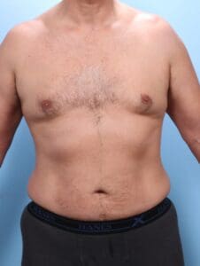 Male Liposuction - Case 1800 - After