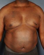 Male Liposuction - Case 1476 - Before