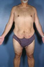After Weight Loss - Case 1153 - Before