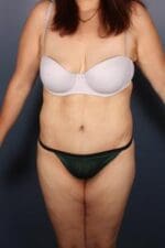 After Weight Loss - Case 1218 - After