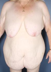 After Weight Loss - Case 413 - Before