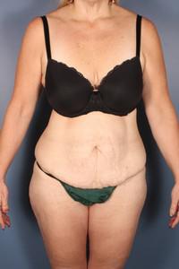 After Weight Loss - Case 1215 - Before
