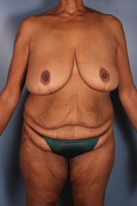 After Weight Loss - Case 1157 - Before