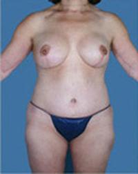 After Weight Loss - Case 1177 - After