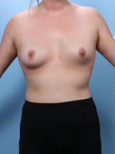 Breast Augmentation - Case 1828 - Before