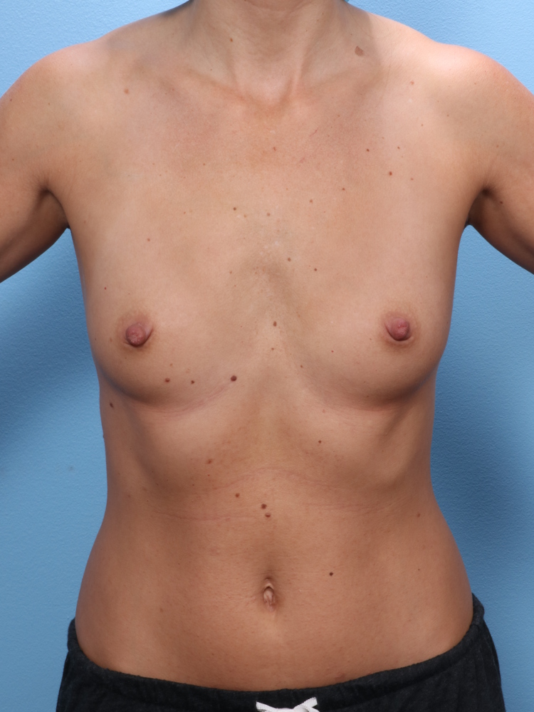 Breast Augmentation - Case 1853 - Before