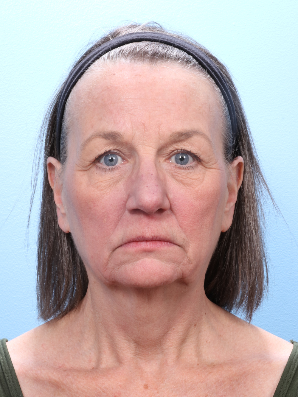 Brow Lift Patient Photo - Case 1857 - before view-0